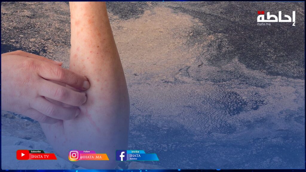طحالب سامة أم تلوث صناعي.. مرض جلدي ونفوق أسماك ورخويات يقلقان ساكنة عين السبع