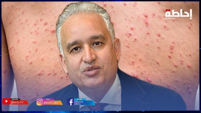 تسجيل أول حالة مُصابة بجدري القردة (إم-بوكس).. حمضي يجيب عن 4 أسئلة مهمة