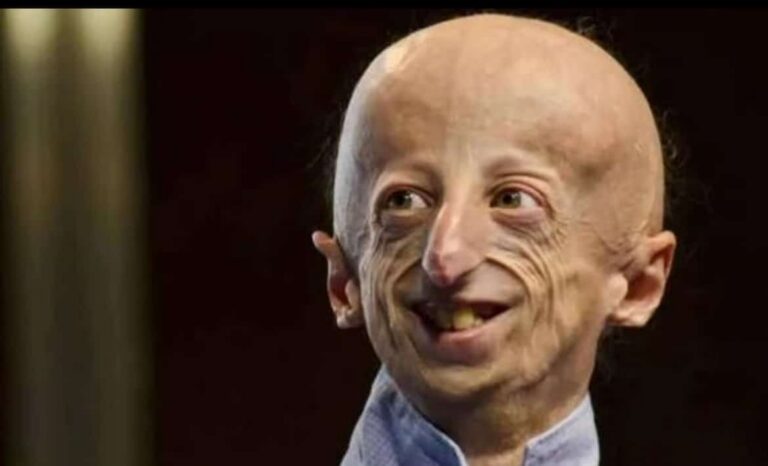 وفاة سامي باسو أكبر مصاب بمتلازمة الشيخوخة المبكرة في العالم