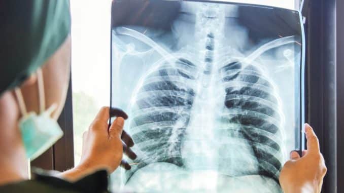 منظمة الصحة العالمية تدعو لاتخاذ إجراءات عاجلة لمكافحة السل